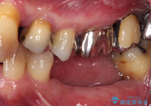 強い咬合力で奥歯がボロボロに インプラント治療による咬合回復と全顎セラミック治療の治療前