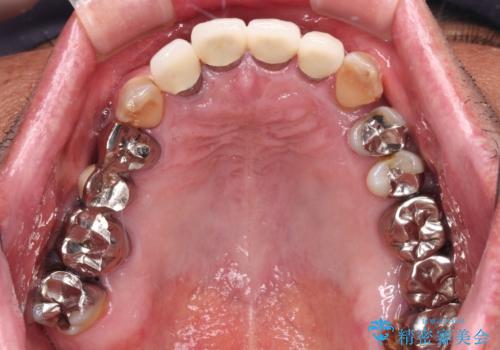 強い咬合力で奥歯がボロボロに インプラント治療による咬合回復と全顎セラミック治療の治療前