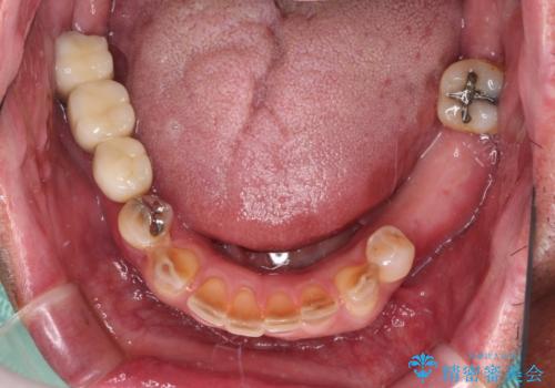 強い咬合力で奥歯がボロボロに インプラント治療による咬合回復と全顎セラミック治療の治療前