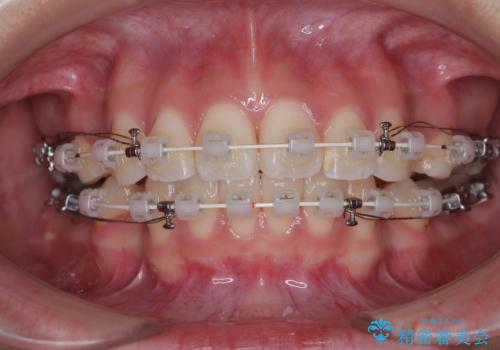 唇を閉じて眠れない ワイヤー装置での抜歯矯正で口元をスッキリとの治療中
