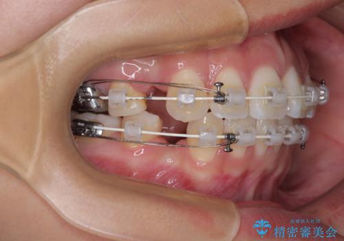 唇を閉じて眠れない ワイヤー装置での抜歯矯正で口元をスッキリとの治療中