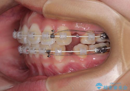 唇を閉じて眠れない ワイヤー装置での抜歯矯正で口元をスッキリとの治療中