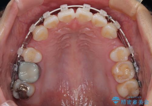 唇を閉じて眠れない ワイヤー装置での抜歯矯正で口元をスッキリとの治療中