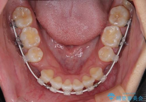 唇を閉じて眠れない ワイヤー装置での抜歯矯正で口元をスッキリとの治療中