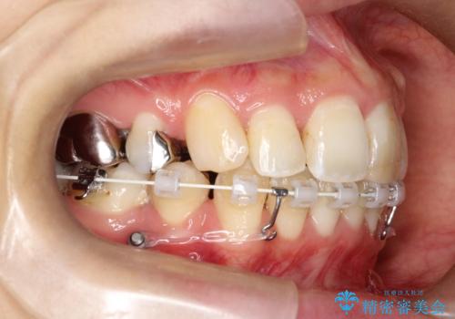 目立たない矯正で口元をすっきりとの治療中