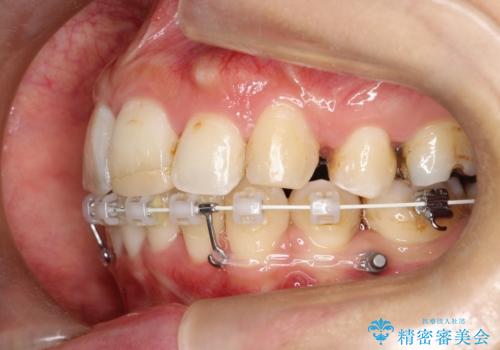 目立たない矯正で口元をすっきりとの治療中