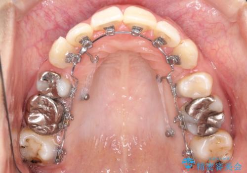 目立たない矯正で口元をすっきりとの治療中