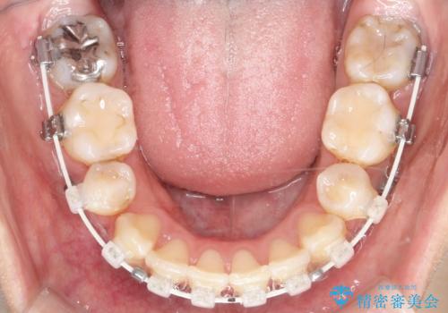 目立たない矯正で口元をすっきりとの治療中