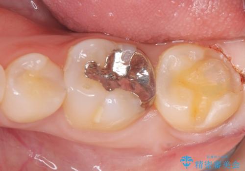 虫歯 〈セラミックインレー〉の治療中