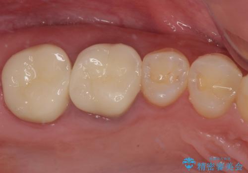 挺出歯を圧下してスペースを確保!目立たない部分矯正で下顎大臼歯にインプラント治療を実現の治療後