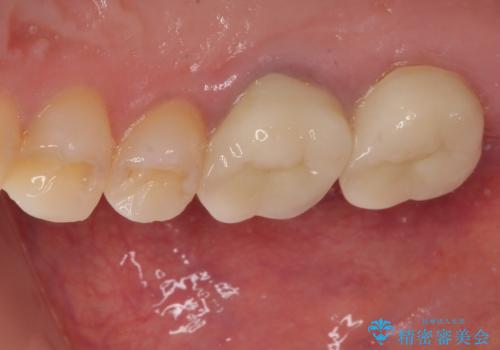 挺出歯を圧下してスペースを確保!目立たない部分矯正で下顎大臼歯にインプラント治療を実現の治療後