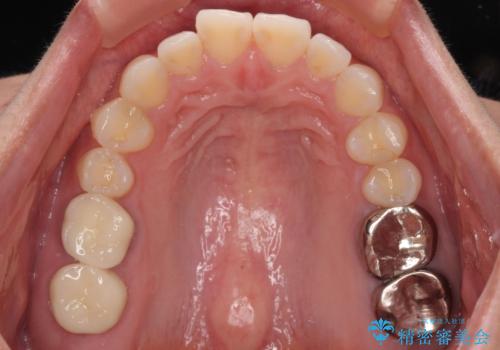 挺出歯を圧下してスペースを確保!目立たない部分矯正で下顎大臼歯にインプラント治療を実現の治療後