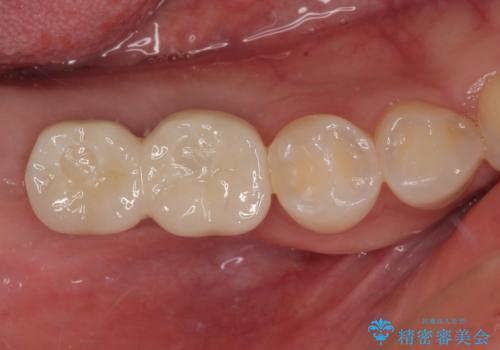 挺出歯を圧下してスペースを確保!目立たない部分矯正で下顎大臼歯にインプラント治療を実現の治療後