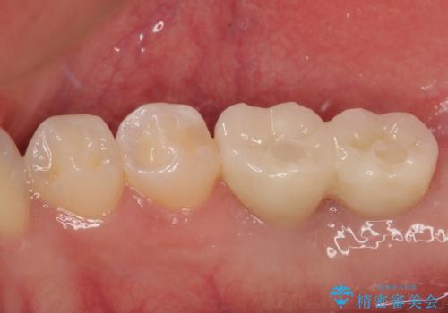 挺出歯を圧下してスペースを確保!目立たない部分矯正で下顎大臼歯にインプラント治療を実現の治療後