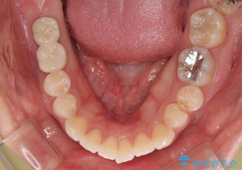 挺出歯を圧下してスペースを確保!目立たない部分矯正で下顎大臼歯にインプラント治療を実現の治療後