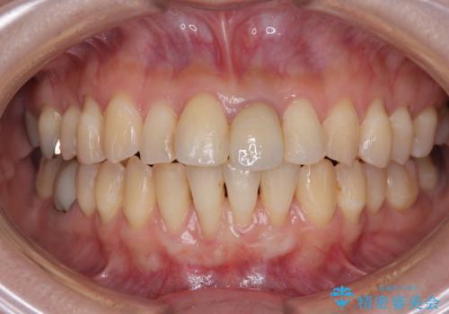 矯正治療で退縮した歯肉 歯肉移植術で露出した歯根を覆い隠すの治療中