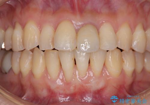 矯正治療で退縮した歯肉 歯肉移植術で露出した歯根を覆い隠すの治療中