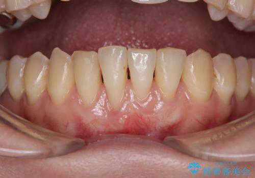 矯正治療で退縮した歯肉 歯肉移植術で露出した歯根を覆い隠すの治療中