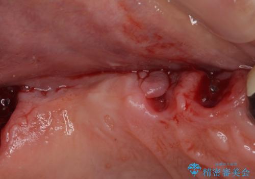 ぐらぐらする奥歯 短期間インプラント治療の治療前