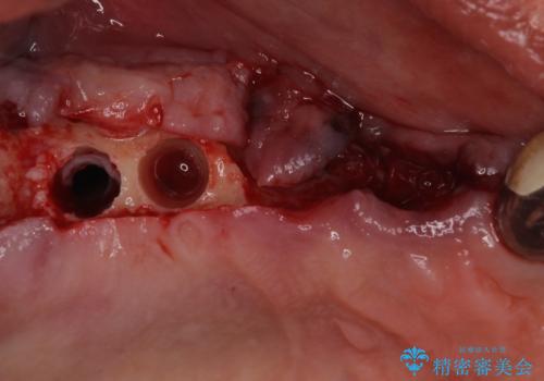 ぐらぐらする奥歯 短期間インプラント治療の治療中