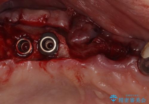 ぐらぐらする奥歯 短期間インプラント治療の治療後