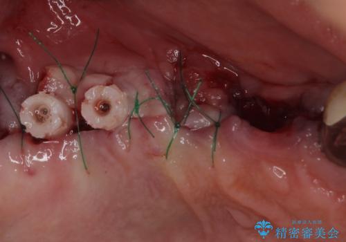 ぐらぐらする奥歯 短期間インプラント治療の治療前