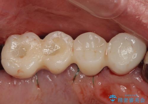 ぐらぐらする奥歯 短期間インプラント治療の治療中