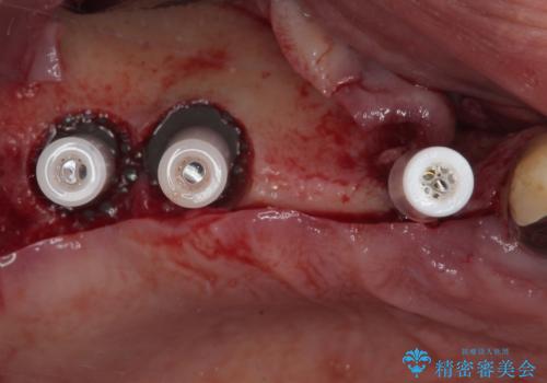 ぐらぐらする奥歯 短期間インプラント治療の治療後