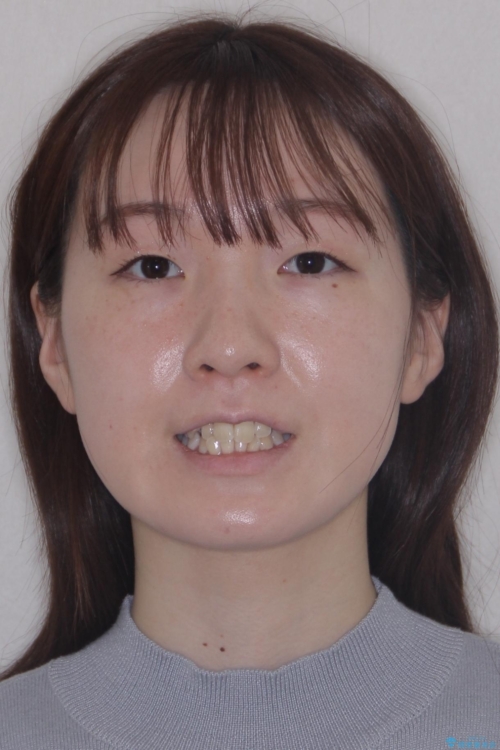 【モニター】前歯のデコボコをスッキリ解消!目立ちにくいワイヤー矯正でスピーディに治療完了の治療前(顔貌)