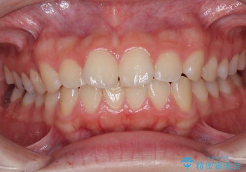 気になる前歯を矯正 短期間のワイヤー矯正治療の症例 治療前