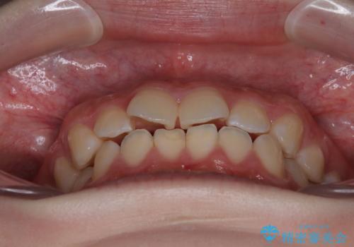 気になる前歯を矯正 短期間のワイヤー矯正治療の治療前