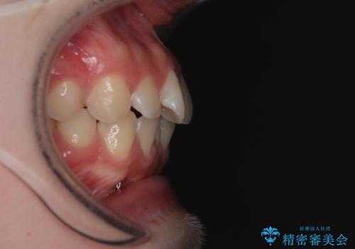 気になる前歯を矯正 短期間のワイヤー矯正治療の治療前