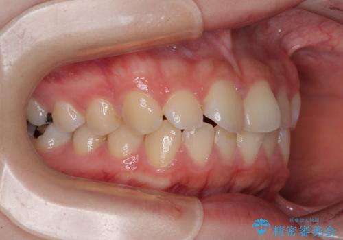 気になる前歯を矯正 短期間のワイヤー矯正治療の治療前