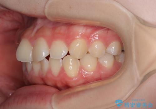気になる前歯を矯正 短期間のワイヤー矯正治療の治療前