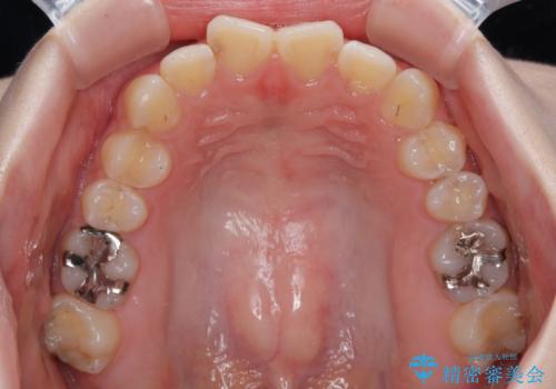 気になる前歯を矯正 短期間のワイヤー矯正治療の治療前