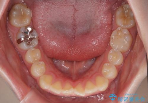 気になる前歯を矯正 短期間のワイヤー矯正治療の治療前