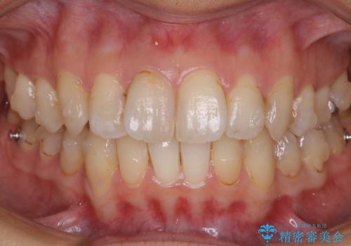【非抜歯】歯を抜かずに歯列をコンパクトに!の治療中