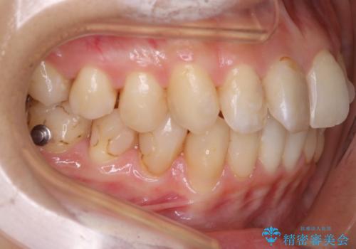 【非抜歯】歯を抜かずに歯列をコンパクトに!の治療中