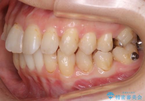 【非抜歯】歯を抜かずに歯列をコンパクトに!の治療中