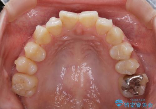 【非抜歯】歯を抜かずに歯列をコンパクトに!の治療中