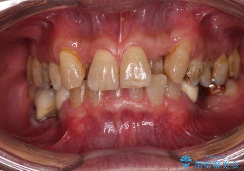 奥歯の欠損と前歯のデコボコを治したい インプラントと矯正治療の総合歯科治療の症例 治療前