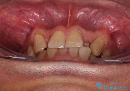 奥歯の欠損と前歯のデコボコを治したい インプラントと矯正治療の総合歯科治療の治療前