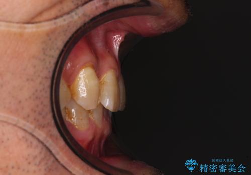 奥歯の欠損と前歯のデコボコを治したい インプラントと矯正治療の総合歯科治療の治療前