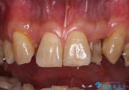 奥歯の欠損と前歯のデコボコを治したい インプラントと矯正治療の総合歯科治療の治療前