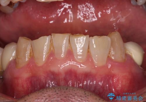 奥歯の欠損と前歯のデコボコを治したい インプラントと矯正治療の総合歯科治療の治療前