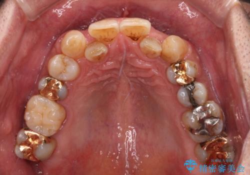 奥歯の欠損と前歯のデコボコを治したい インプラントと矯正治療の総合歯科治療の治療前