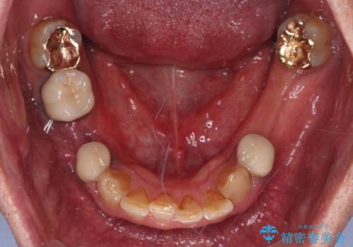 奥歯の欠損と前歯のデコボコを治したい インプラントと矯正治療の総合歯科治療の治療前