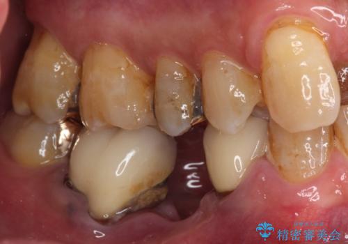 奥歯の欠損と前歯のデコボコを治したい インプラントと矯正治療の総合歯科治療の治療前