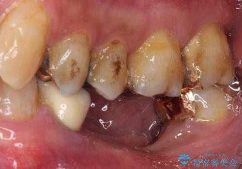 奥歯の欠損と前歯のデコボコを治したい インプラントと矯正治療の総合歯科治療の治療前