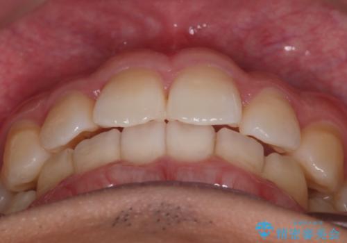 【インビザライン】目立たない矯正で前歯を綺麗にの治療後